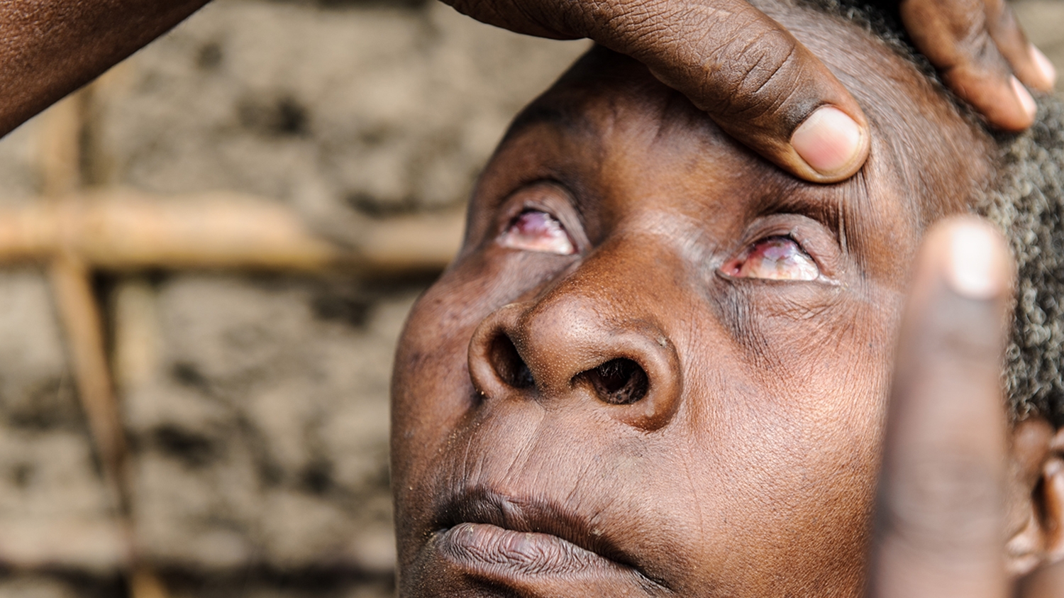 Aluna, who has advanced trachoma, has her eyes examined by an eye health worker.