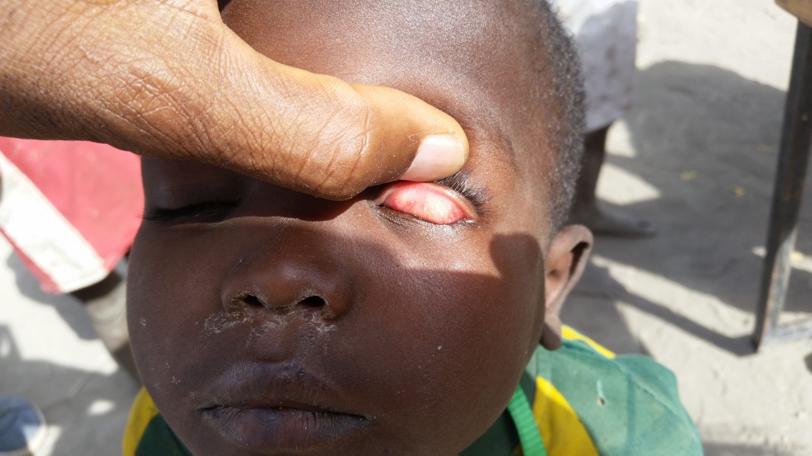 A boy's eyelid is checked for signs of trachoma