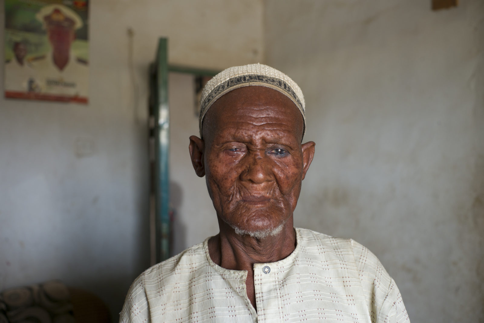 A man with trachoma looks down away from the camera. He is indoors and wearing a white hat and top.