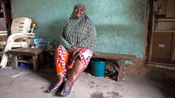 A woman with visible signs of lymphatic filariasis sits on a bench.